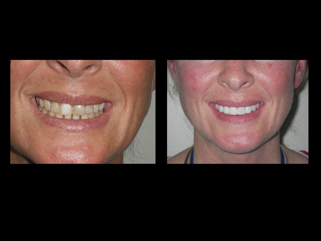before and after photo of a dental care patient
