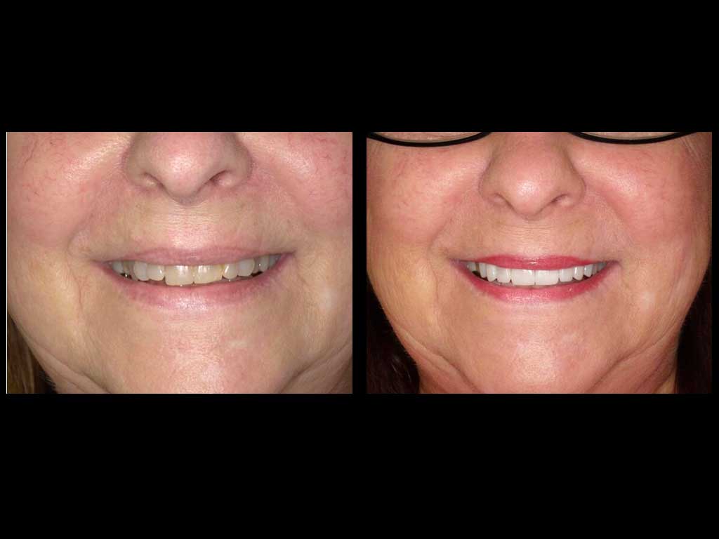 before and after photo of a dental care patient